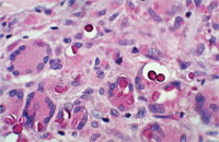 Cryptococcosis. Periodic acid–Schiff stain with diastase demonstrating budding yeast surrounded by a clear space representing the capsule. (Courtesy of the Fitzsimons Army Medical Center teaching files.)